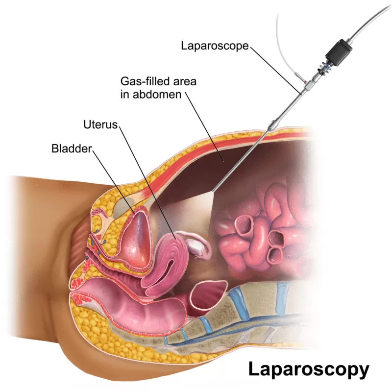Gynaec Laparoscopy